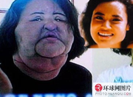 韩国48岁女子整容上瘾 致脸变肿成丑八怪
