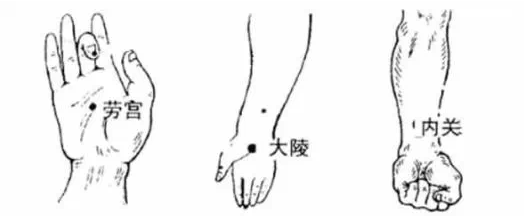 按:推揉五穴保心 心包经有三个穴位要经常按揉,劳宫穴,大陵穴,内关穴