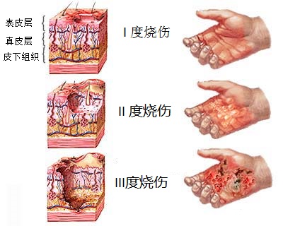 烧伤后不能用冰敷,你知道吗?