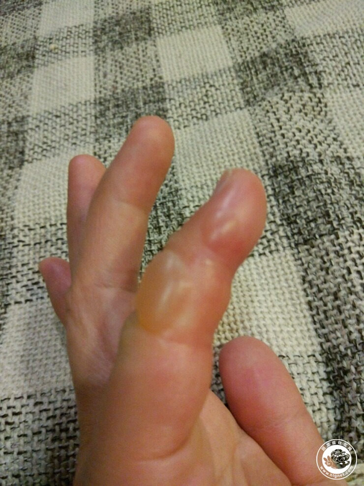 小手指居然冻肿了还起了水泡